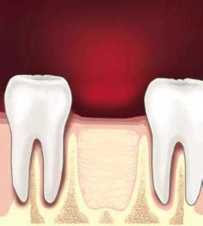 Tooth-Extraction-Poland
