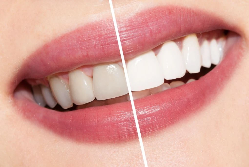 dentalna-estetika