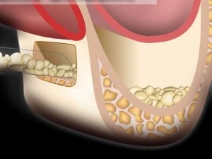 sinus-lift1